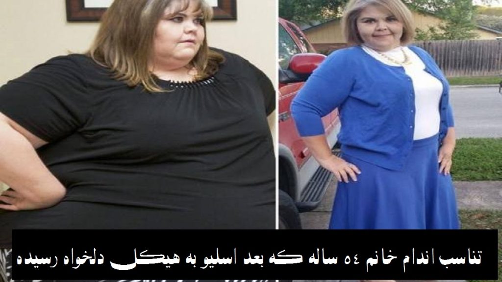 تصویر قبل و بعد عمل اسلیو معده در خانم 54 ساله خارجی