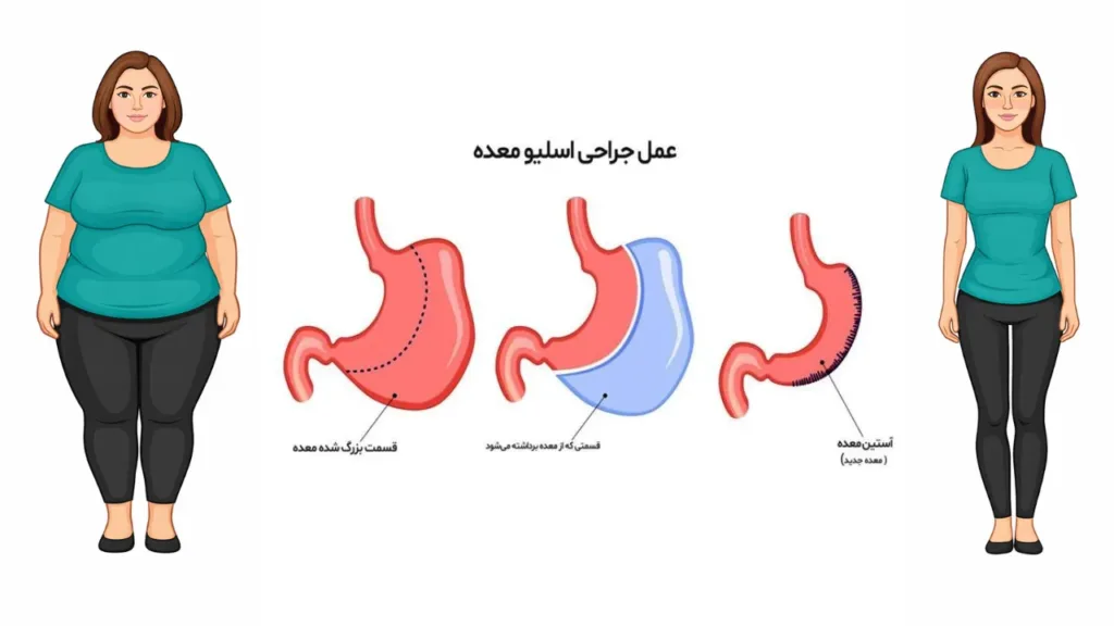 تصویر قبل و بعد عمل اسلیو معده 