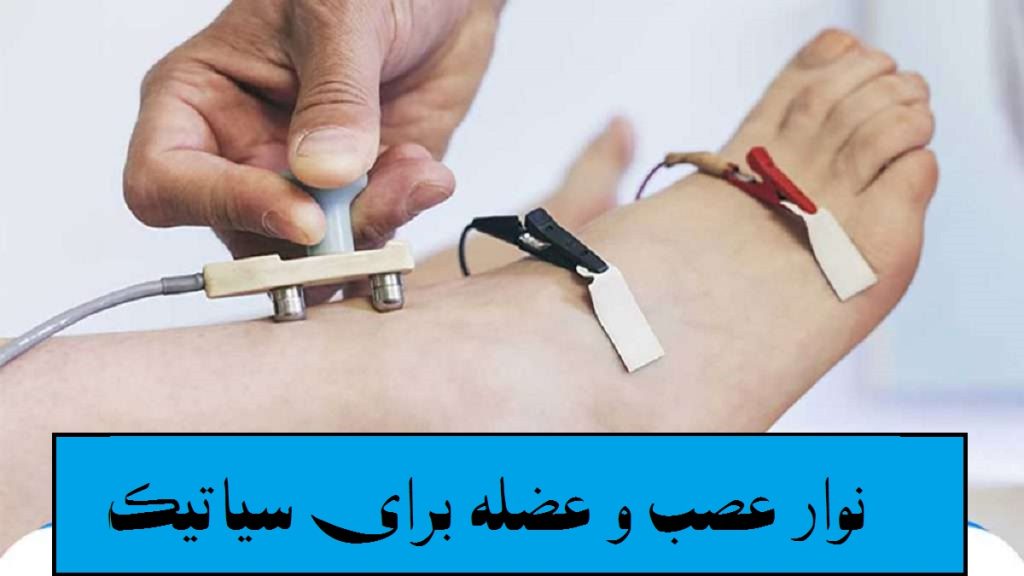 نوار عصب و عضله برای سیاتیک