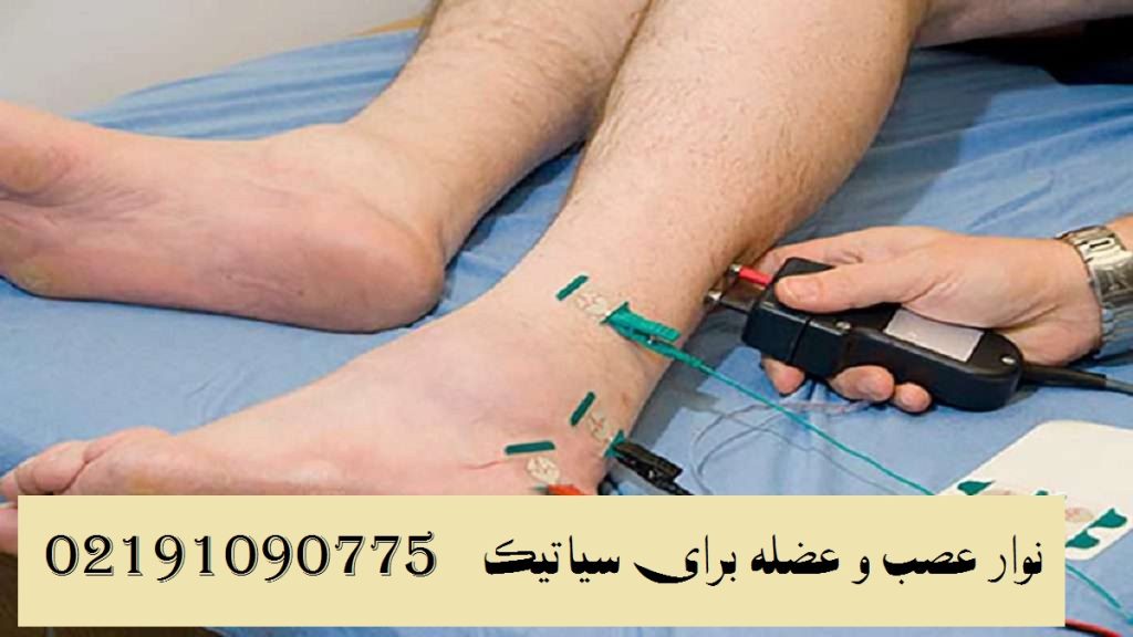 نوار عصب و عضله برای سیاتیک