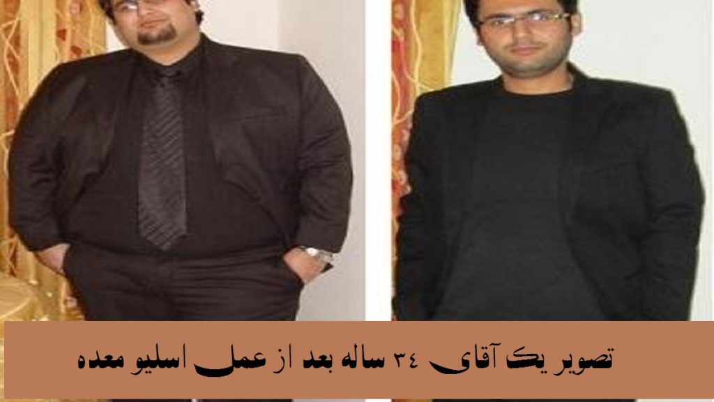 عکس یک اقای 34 ساله قبل و بعد عمل اسلیو معده و لاغری آن