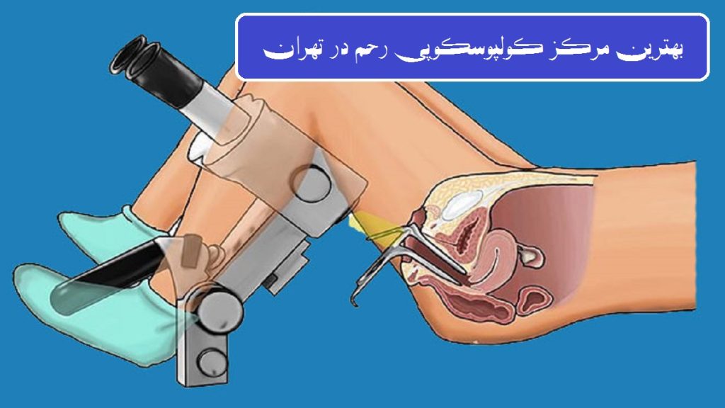 مراکز کولپوسکوپی رحم در تهران - تصویر انیمیشنی از کولپوسکوپی رحم