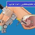 مراکز کولپوسکوپی رحم در تهران - تصویر انیمیشنی از کولپوسکوپی رحم