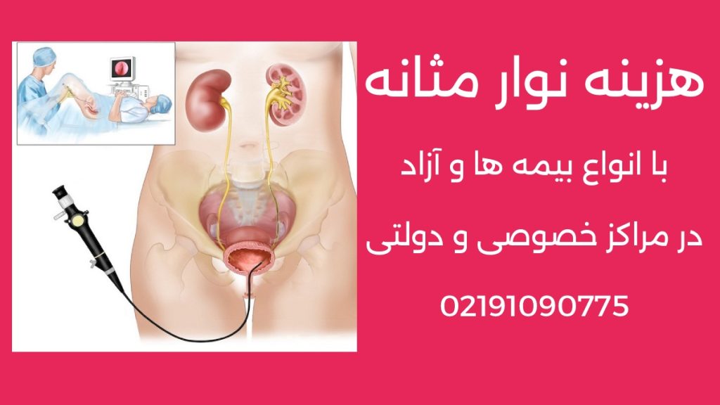 هزینه نوار مثانه در بهترین مرکز خصوصی تهران توسط اورولوژیست خانم