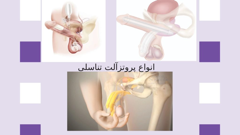 تصویری از سه مدل پروتزآلت تناسلی 